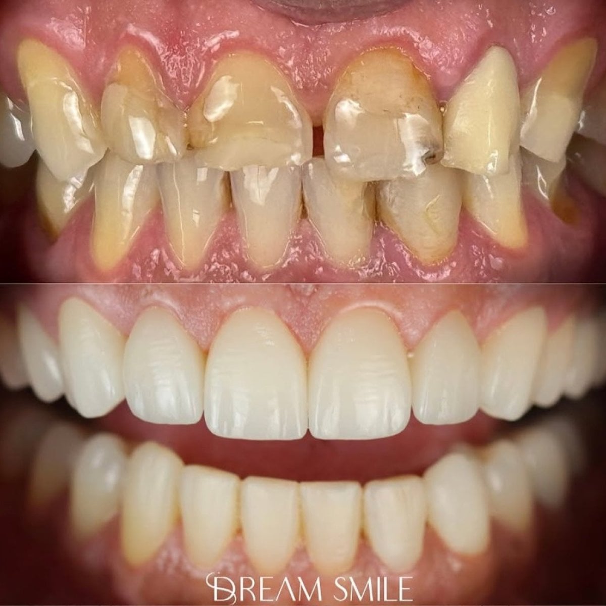 قبل وبعد الفينير في Dream Smile – تحول ملحوظ للابتسامة ونتيجة أسنان أكثر بياضًا