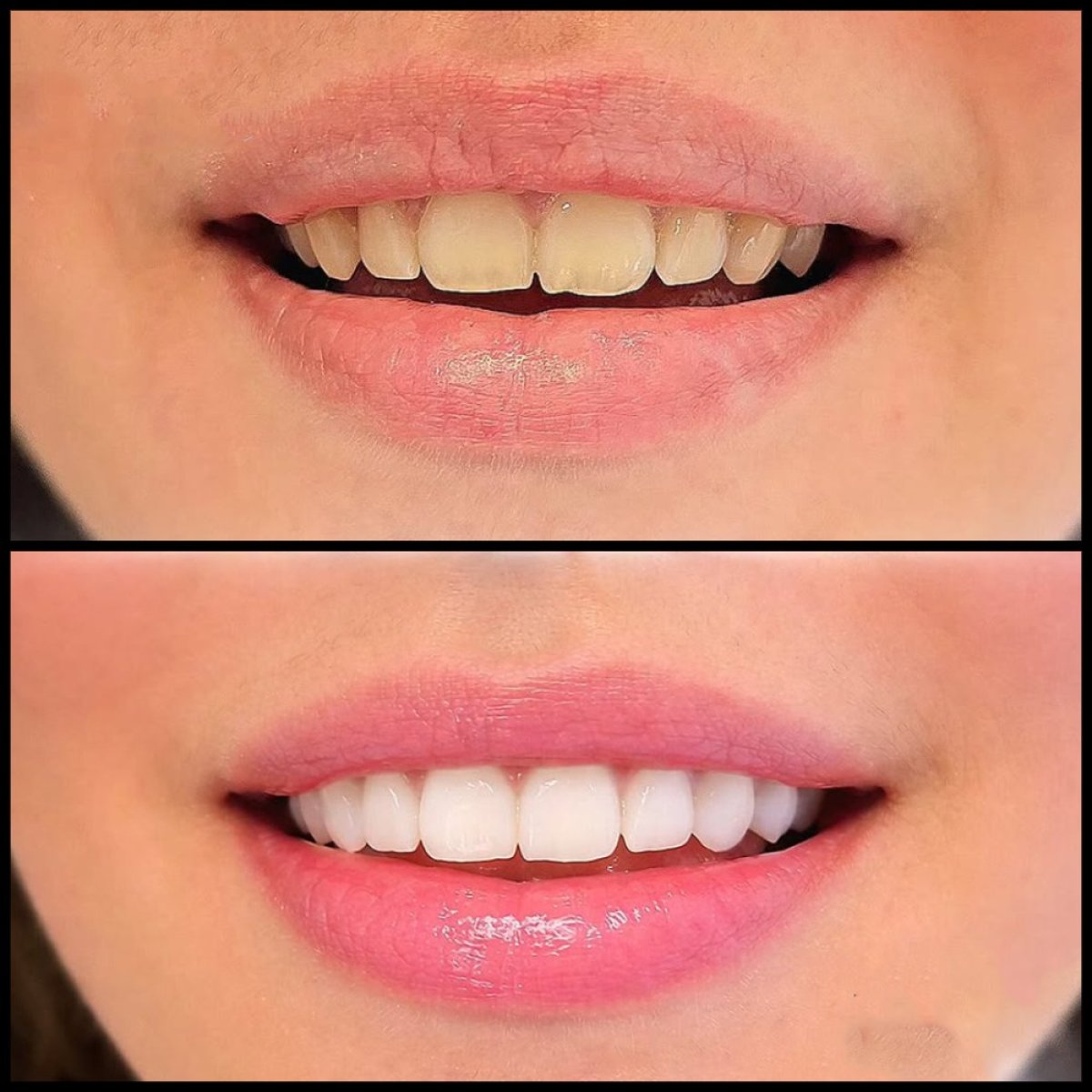Resultados de blanqueamiento dental antes y después en IBS | Dental Clinic, sonrisa más blanca