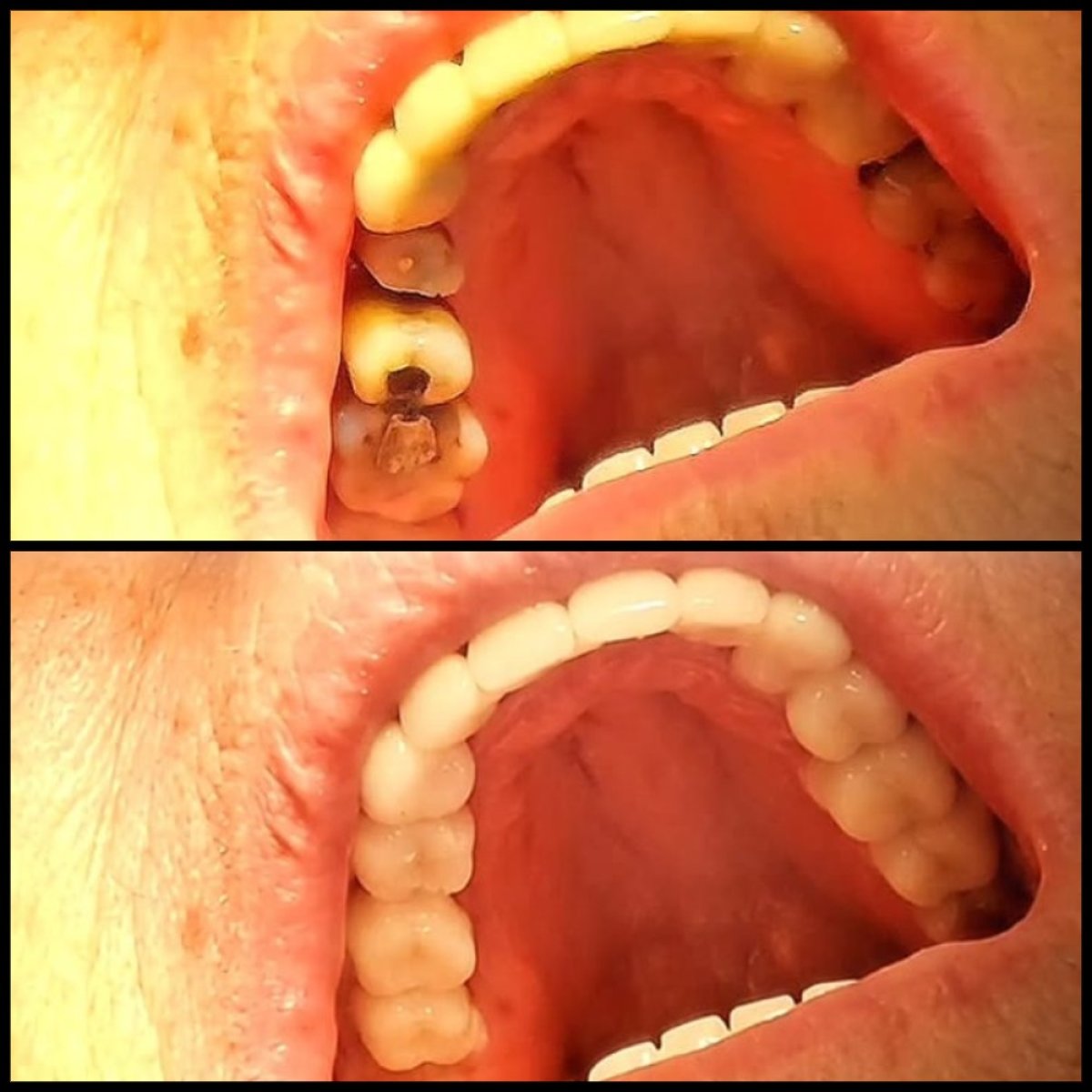 نتائج قبل وبعد تركيب تيجان الأسنان في IBS | Dental Clinic، ترميم الأسنان العلوية