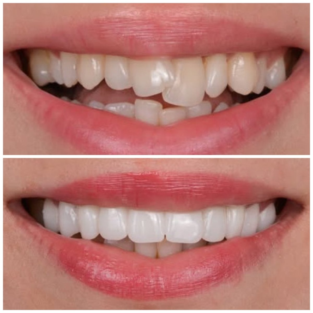 Resultados antes y después de coronas de zirconia en TRAKYADENT DENTAL HEALTH GROUP
