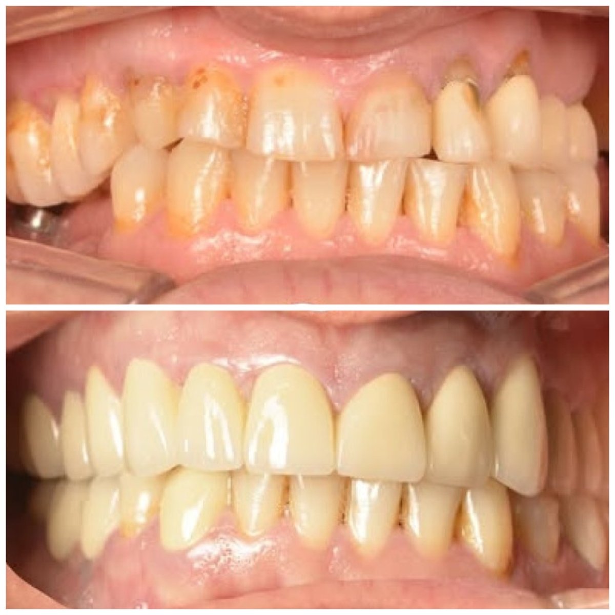 قبل وبعد تركيب تيجان PFM في TRAKYADENT DENTAL HEALTH GROUP، نتيجة استعادة الابتسامة