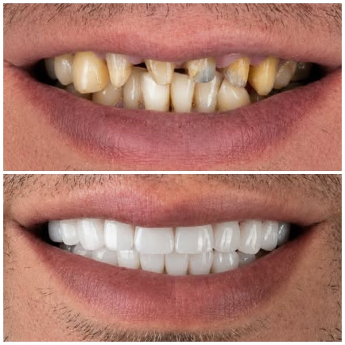 Antes y después de coronas dentales en TRAKYADENT DENTAL HEALTH GROUP, resultado de sonrisa