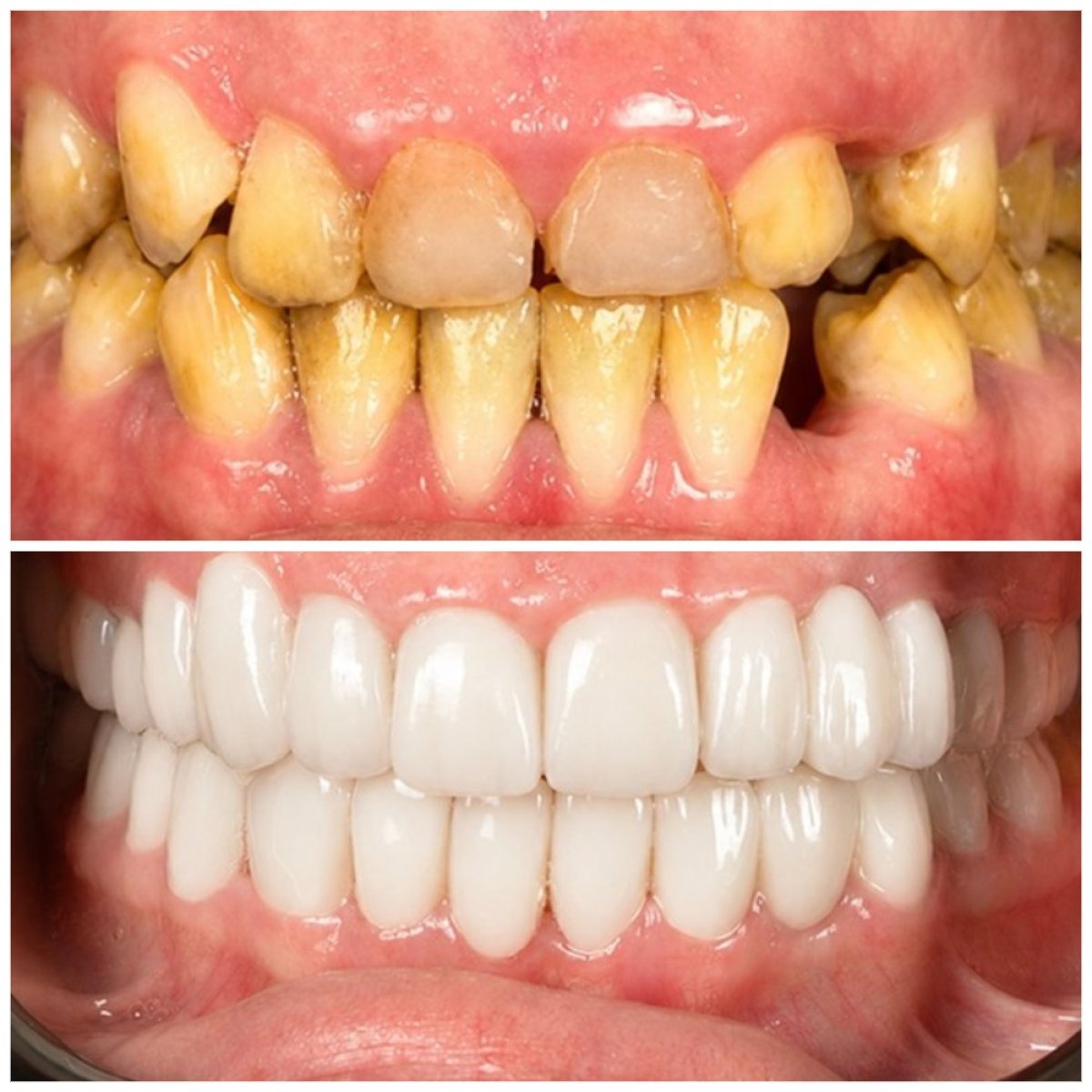 نتائج قبل وبعد ابتسامة هوليود في TRAKYADENT DENTAL HEALTH GROUP، تحول الابتسامة