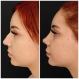 نتائج عملية تجميل الأنف قبل وبعد في مستشفى Egepol، تحسين شكل الأنف والملامح