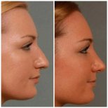 نتائج عملية تجميل الأنف قبل وبعد في مستشفى إيجبول، تحسين شكل الأنف والملف الجانبي