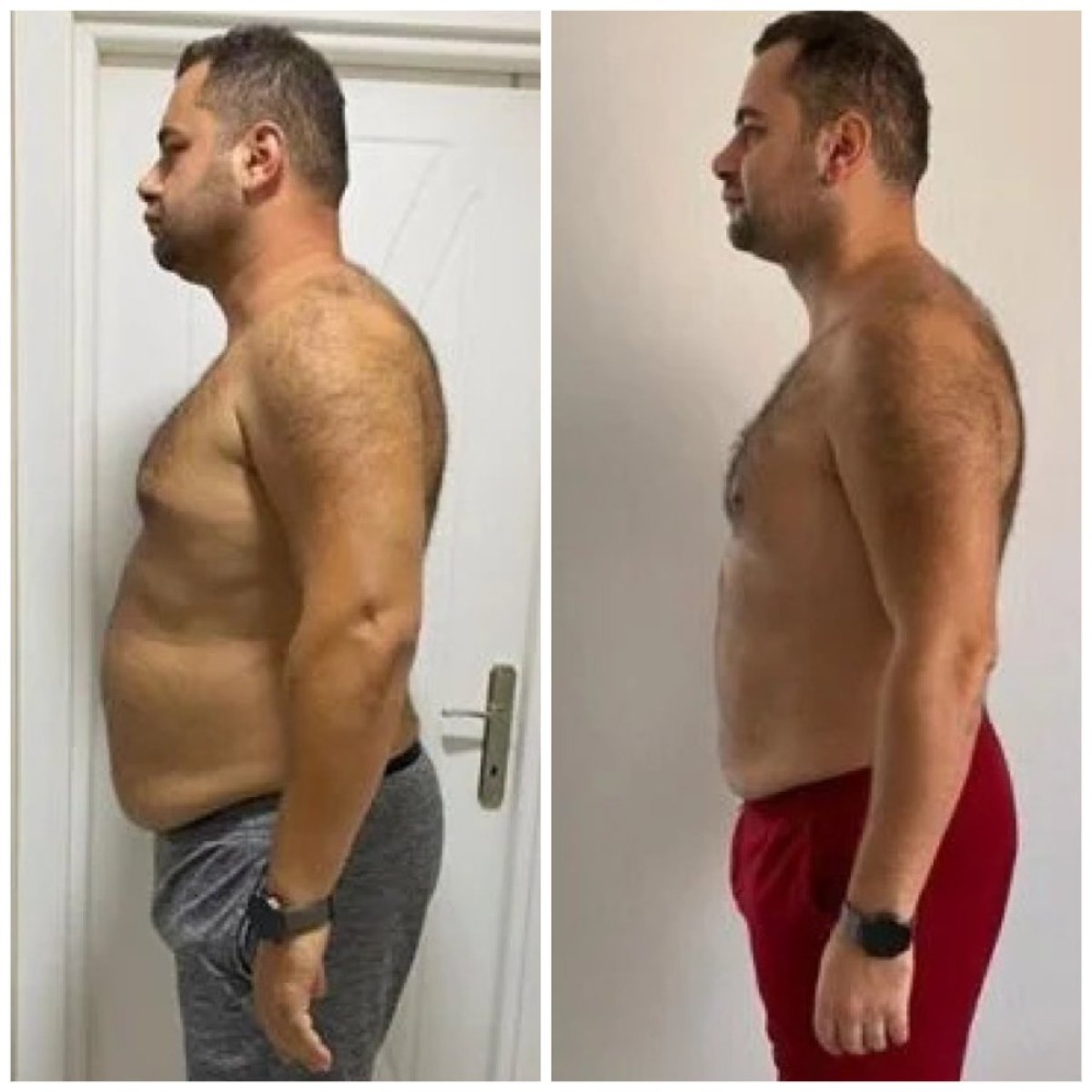 Resultados de abdominoplastia antes y después en Egepol Hospitals, mejora del contorno abdominal