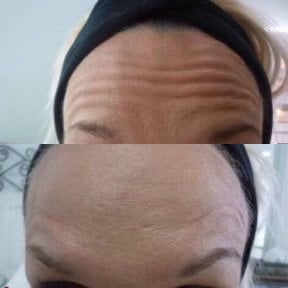 Before and after Botox injections at Nicha Clinic Pattaya – smoother forehead wrinkle results