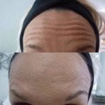 Before and after Botox injections at Nicha Clinic Pattaya – smoother forehead wrinkle results