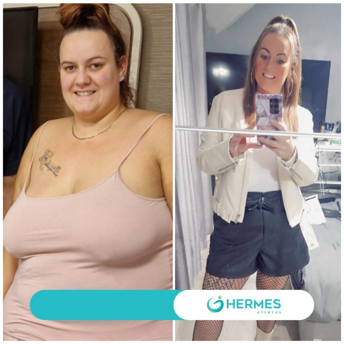 قبل وبعد عملية تكميم المعدة في Hermes Clinics – نتيجة فقدان وزن واضحة