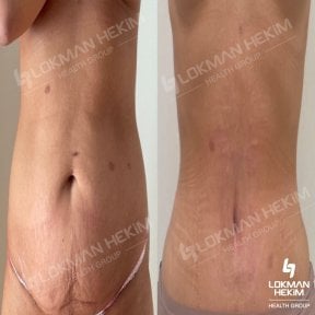 before-after photo korrekcia-figury-mommy-makeover