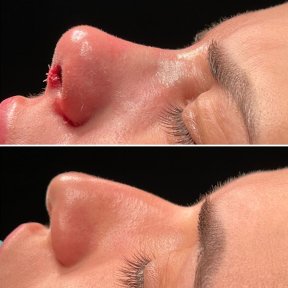 before-after photo povtornaa-rinoplastika-revizionnaa-rinoplastika