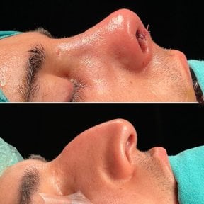 before-after photo povtornaa-rinoplastika-revizionnaa-rinoplastika