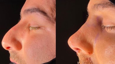 before-after photo povtornaa-rinoplastika-revizionnaa-rinoplastika