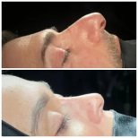 نتائج عملية تجميل الأنف قبل وبعد في DR. CINIK HOSPITAL، تحسين شكل الأنف