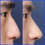 نتائج تجميل الأنف قبل وبعد في عيادة WillBe Plastic Surgery، تحسين شكل الأنف