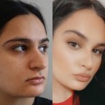 نتائج عملية تجميل الأنف قبل وبعد في عيادة Ekrem Keskin مع تعديل طبيعي للأنف
