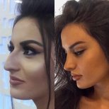 نتائج عملية تجميل الأنف قبل وبعد في عيادة Ekrem Keskin مع تحسين شكل الأنف