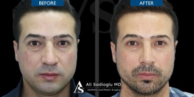 before-after photo rhinoplasty-nose-job