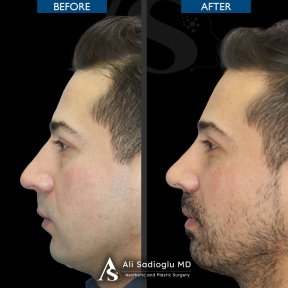 before-after photo rhinoplasty-nose-job