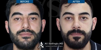 before-after photo rhinoplasty-nose-job