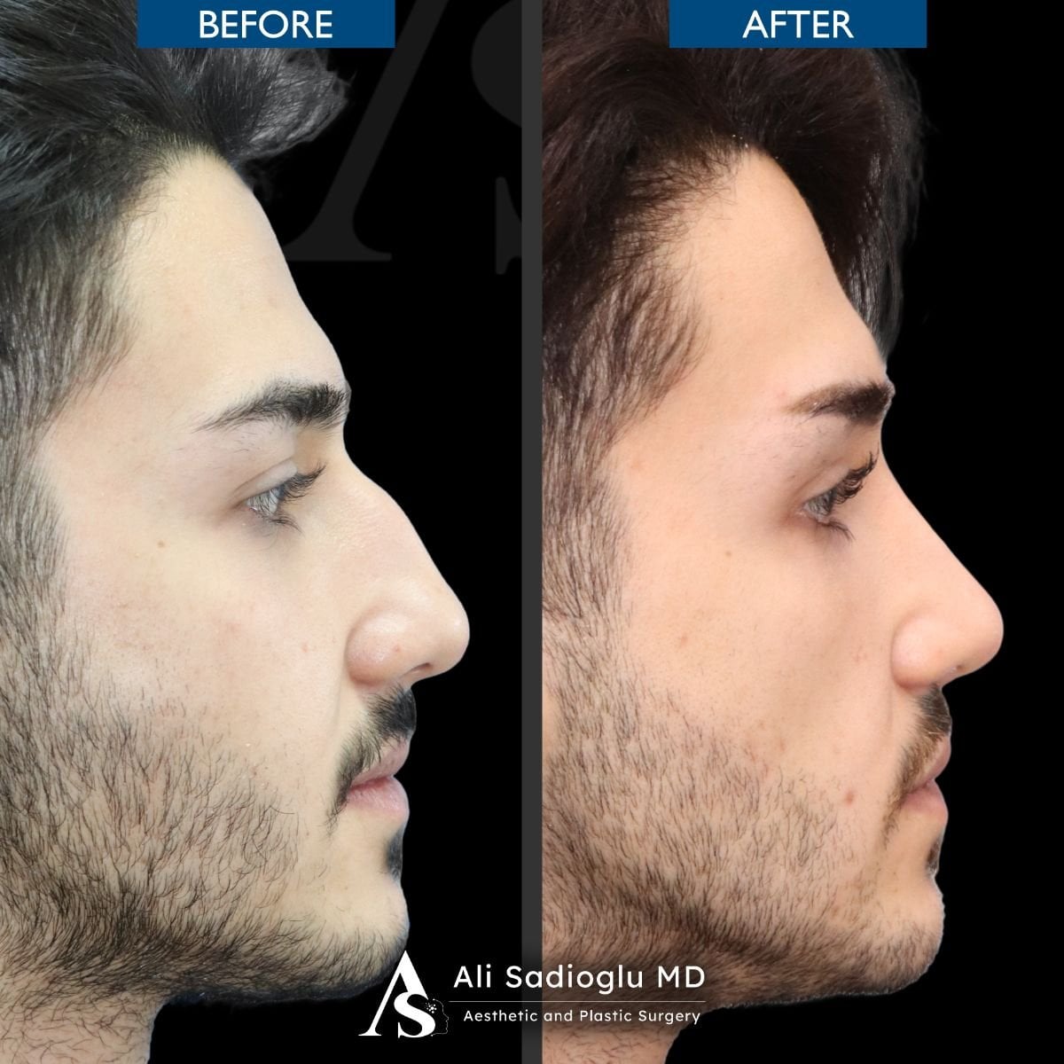 Resultados de rinoplastia antes y después en Dr. Safa Manav Clinic, perfil nasal mejorado