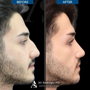 before-after photo rhinoplasty-nose-job
