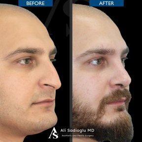 before-after photo rhinoplasty-nose-job