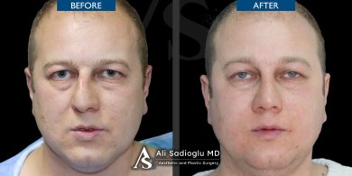 before-after photo rhinoplasty-nose-job