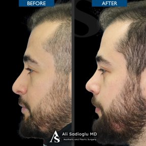 before-after photo rhinoplasty-nose-job