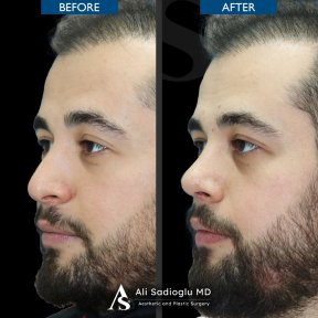 before-after photo rhinoplasty-nose-job