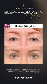 before-after photo droopy-eyelid-surgery