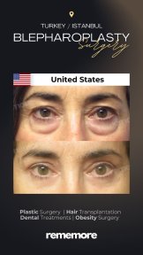before-after photo droopy-eyelid-surgery