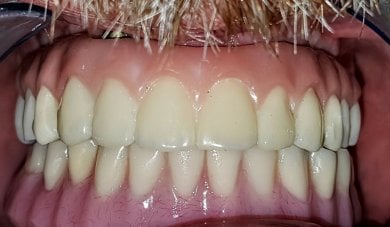 before-after photo all-on-4-dental-implants