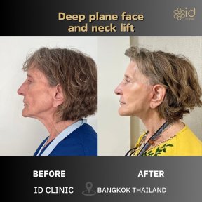 before-after photo deep-plane-facelift
