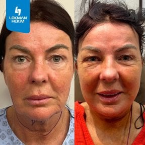 Before and after blepharoplasty results at Lokman Hekim Istanbul Hospital, eyelid correction