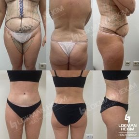 Before and after thigh liposuction results at Lokman Hekim Istanbul Hospital, body contouring
