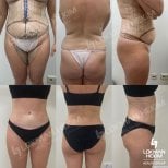 Before and after thigh liposuction results at Lokman Hekim Istanbul Hospital, body contouring