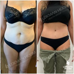 Before and after thigh liposuction results at Lokman Hekim Istanbul Hospital, body contouring