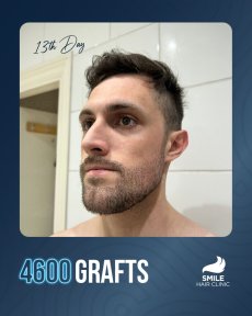 Beard transplant result at Smile Hair Clinic, 4600 grafts, 13th day post-procedure