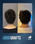 Before and after 4600 grafts hair transplant result at Smile Hair Clinic, improved hair density