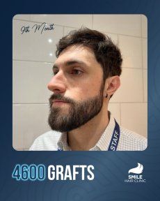 Beard transplant result at Smile Hair Clinic after 4600 grafts, 9 months post-procedure