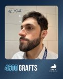 Beard transplant result at Smile Hair Clinic after 4600 grafts, 9 months post-procedure