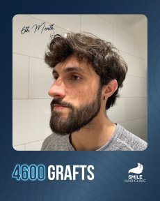 Beard transplant result at Smile Hair Clinic, 4600 grafts, 6 months after procedure