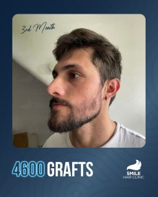 Beard transplant result at Smile Hair Clinic, 4600 grafts, 3 months post-procedure