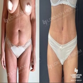 Before and after breast lift results at Lokman Hekim Istanbul Hospital, visible body contouring