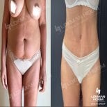 Before and after breast lift results at Lokman Hekim Istanbul Hospital, visible body contouring
