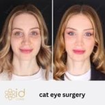 Before and after cat eye surgery results at ID Clinic Bangkok, enhanced eye shape visible