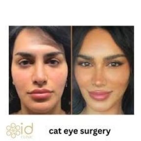 Before and after cat eye surgery results at ID Clinic Bangkok, enhanced almond-shaped eyes