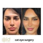 Before and after cat eye surgery results at ID Clinic Bangkok, enhanced almond-shaped eyes