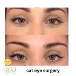 Before and after cat eye surgery results at ID Clinic Bangkok, lifted outer eye corners